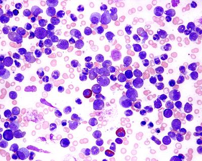 Wenetoklaks odblokowuje w komórkach CLL apoptozę – naturalny proces obumierania