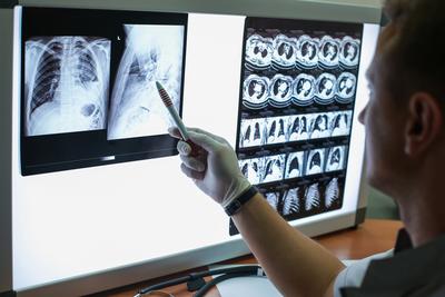 Groźnym zjawiskiem jest fakt, że każdego roku wykrywanych jest ponad 2500 przypadków gruźlicy wysoce zakaźnej, czyli z dodatnim wynikiem bakterioskopii.
