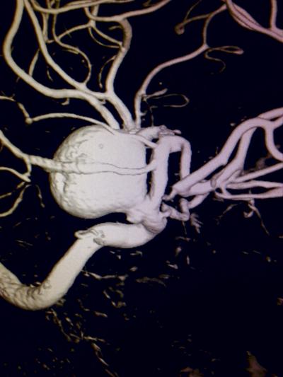 TĘTNIAK OLBRZYMI Rekonstrukcja 3D badania DSA (Digital Subtraction Angiography) - cyfrowa angiografia subtrakcyjna