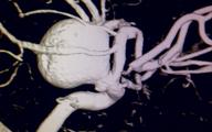 Precyzyjne i bezpieczne neuroendowaskularne leczenie tętniaków mózgu