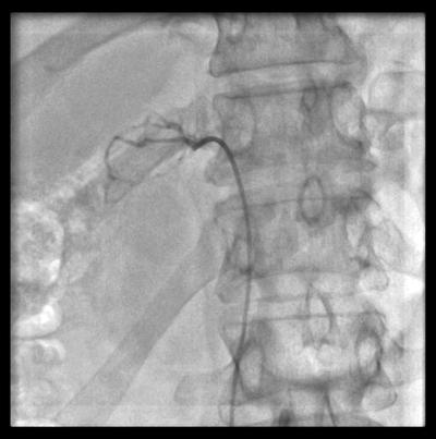 ANGIOGRAFIA prawej żyły nadnerczowej
z widocznym umieszczonym w niej cewnikiem
C2 (strzałka).