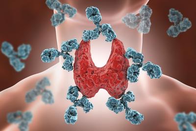 Olbrzymia nadrozpoznawalność choroby Hashimoto w dzisiejszych czasach wynika z nagminnego diagnozowania jej jedynie na podstawie podwyższonego stężenia przeciwciał anty-TPO.