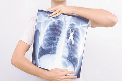 Leczenie chorych na niedrobnokomórkowego raka płuca (NDRP) stanowi dla specjalistów duże wyzwanie. Pojawienie się leków immunokompetentnych poszerzyło możliwości terapii.