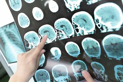 W neurologii dokonała się prawdziwa rewolucja w diagnostyce chorób mózgu