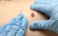 24 wyspecjalizowane ośrodki obejmą opieką pacjentów z zaawansowaną postacią czerniaka