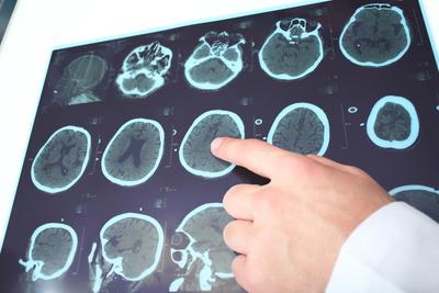 Rozpoznanie SM jest trudne. Zarówno objawy, jak i wyniki badania obrazowego rezonansem magnetycznym mogą przypominać np. udar, migrenę czy niedobór witaminy B12.