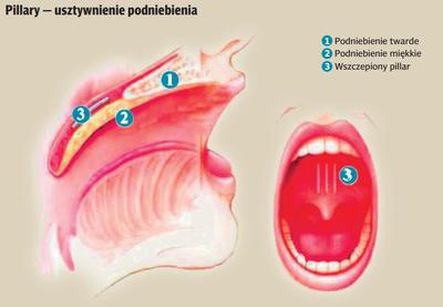 Pillary – usztywnienie podniebienia