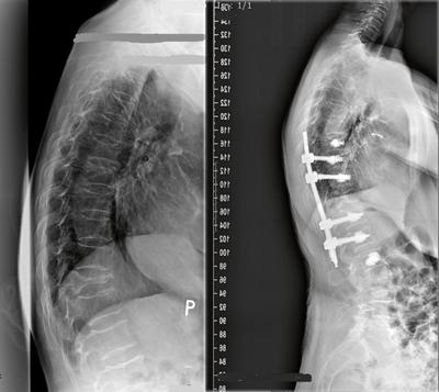 Mało inwazyjny zabieg przezskórnej stabilizacji kręgosłupa u 81-letniej pacjentki ze złamanym kręgiempiersiowym Th11 i zaawansowaną osteoporozą - sylwetka pacjentki przed i po operacji.