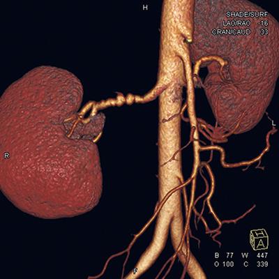 Obraz w angiografii tomografii komputerowej dysplazji włóknisto-mięśniowej zlokalizowanej w obrębie pnia prawej tętnicy nerkowej - zmiana wieloogniskowa (multifocal), określana również jako sznur paciorków.