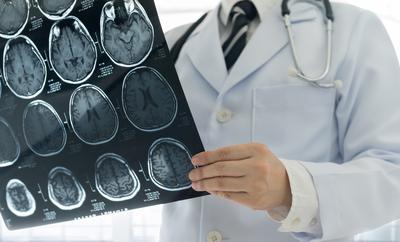Zdaniem neurologa dr. Fotuhi, osoby, które przeszły COVID-19, przed wypisem ze szpitala powinny mieć wykonane badanie MRI i być monitorowane jeszcze przez kolejne miesiące pod względem zdrowia mózgu.