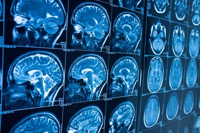 Choroba Alzheimera jest jedną najczęściej występujących demencji