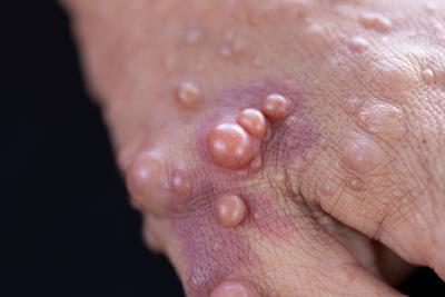 Neurofibromatoza (nerwiakowłókniakowatość) to choroba genetyczna zniekształcająca skórę chorych.