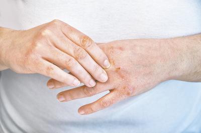 U osób z AZS dochodzi do nieprawidłowości w rozwoju wczesnej odpowiedzi immunologicznej, czego wynikiem jest nasilanie się stanu zapalnego pod wpływem czynników drażniących oraz mikroorganizmów.